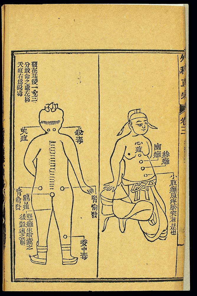 Chinese woodcut: Abscesses -- 'heart abscess', etc.