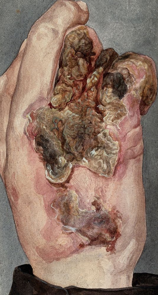 Lupus vulgaris: an inflamed, infected hand. Watercolour, 1900/1950.