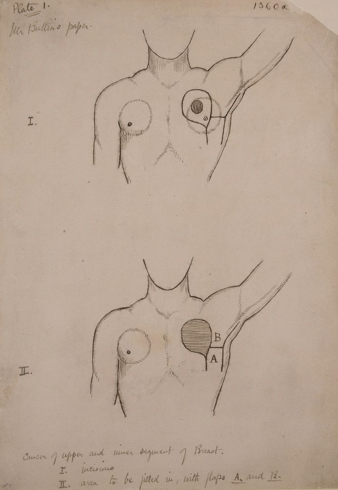 Methods of arranging skin flaps after mastectomy operations (plate 1)