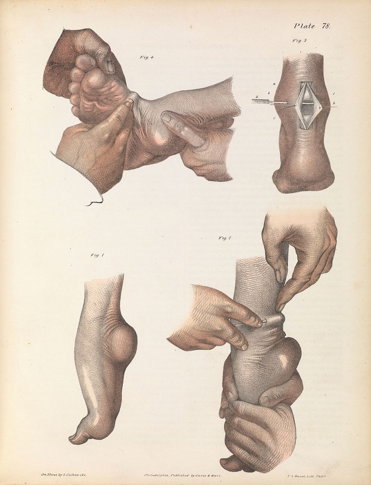 Plate LXXVIII. Surgical techniques to repair club-foot.