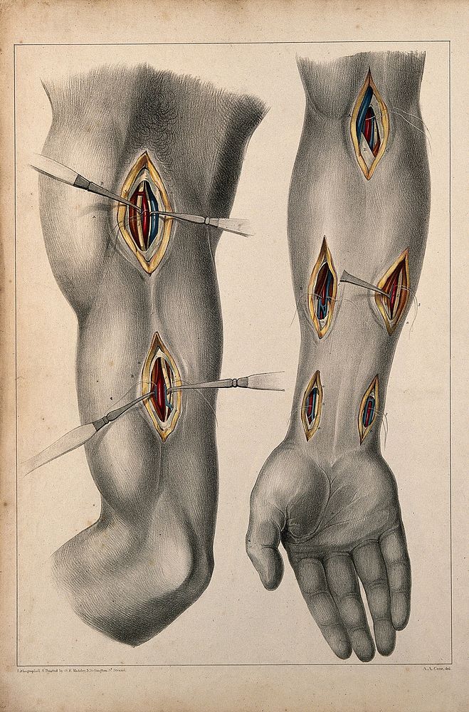 Surgery of the arteries of the arm: two figures showing incisions in the upper and lower arm, with surgical instruments…