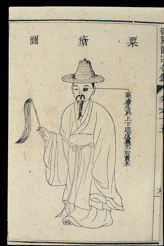 Chinese C18 woodcut: The eye - 'millet sores' on eyelid