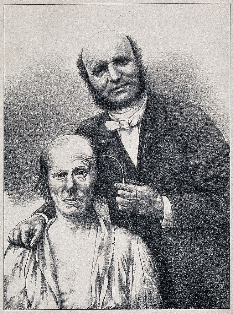 Guillaume Benjamin Amand Duchenne de Boulogne stimulating a patient's facial muscle with a faradic current. Lithograph, ca.…