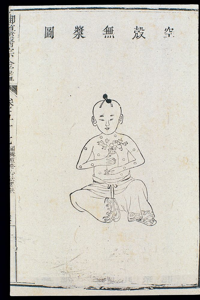 Chinese C18: Paediatric pox - 'Empty shell without pulp'