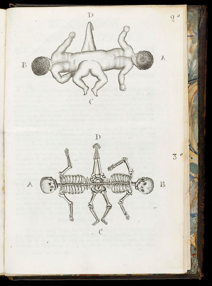 Plates showing two sets of conjoined infants. Plate 3a shows how their skeletons are joined