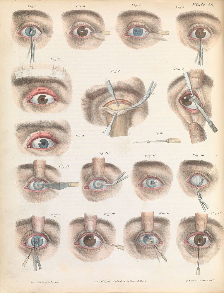 Plate XLIX. Various surgical treatments on the eye.