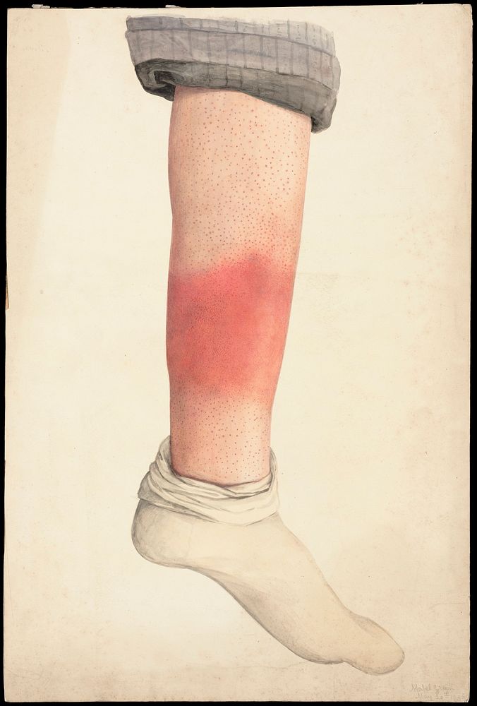The shin of a boy with a rash; rolled trouser-leg and sock in place. Watercolour by Mabel Green, 1896.