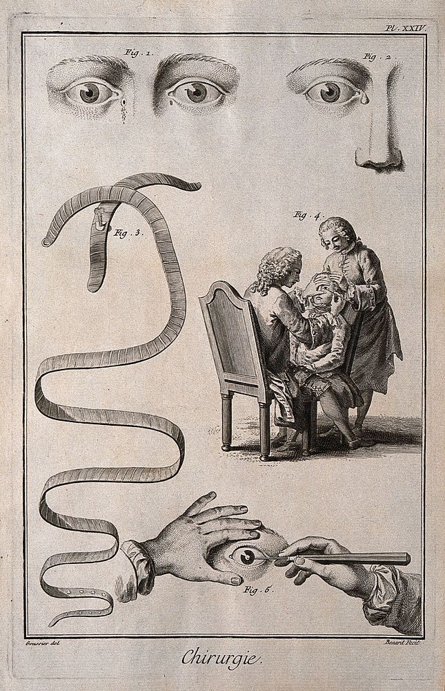 Surgery: instruments for the treatment of cataracts and fistulas of the lacrimal canals. Engraving by R. Benard after Louis…