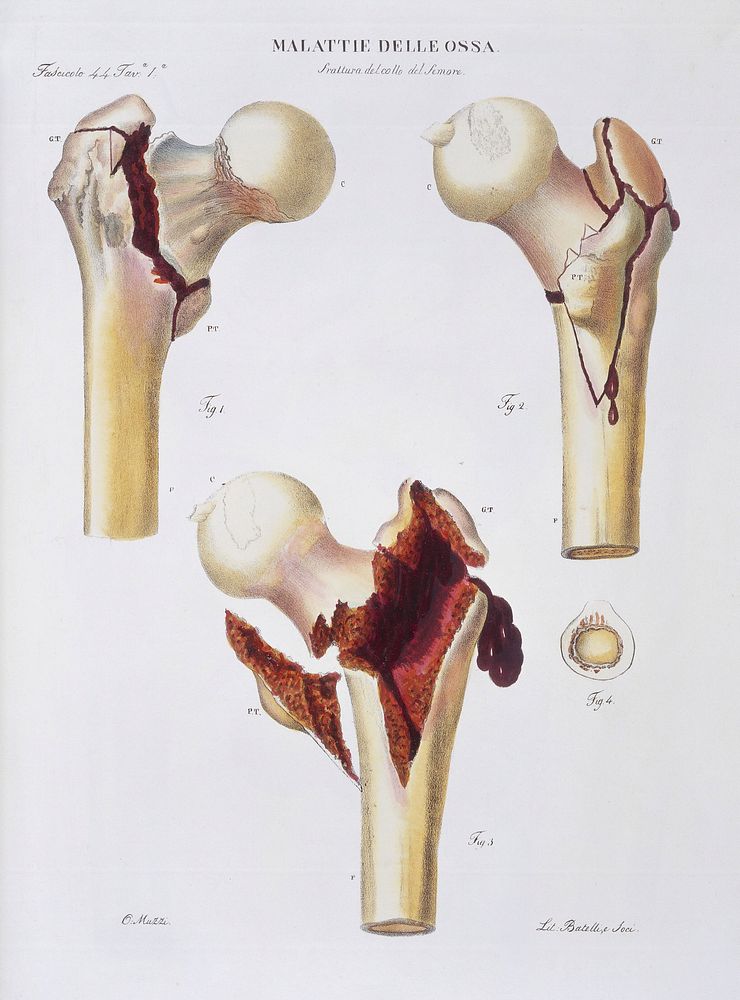 Diseases of the bones