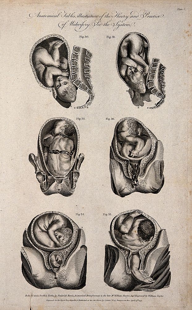 Six diagrams of babies in different delivery positions in the womb. Engraving by W. Taylor, 1791, after F. Birnie after W.…