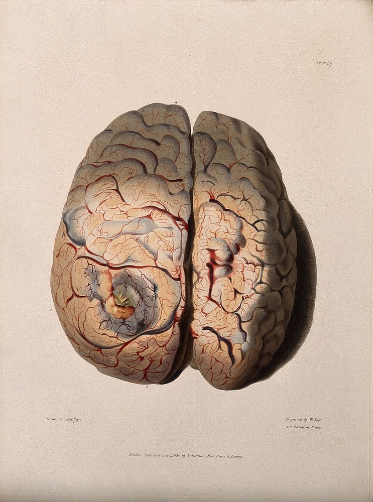 A diseased brain. Coloured stipple etching by W. Say after F. R. Say for Richard Bright, 1829.