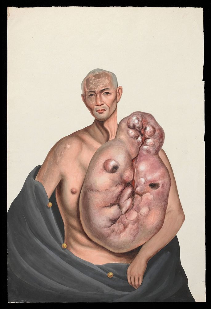 A man (Woo Kinshing), facing front, with a massive tumour on the left side of his trunk. Gouache, 18--, after Lam Qua, 1837.