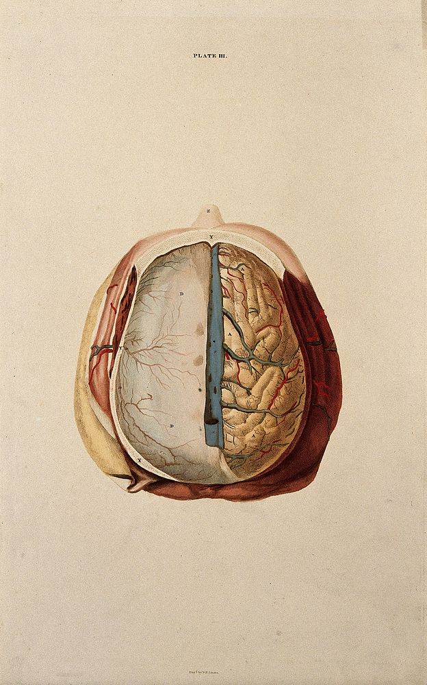 Brain: dissection showing the top of the brain, with the dura mater of the left hemisphere and the gyri of the right.…
