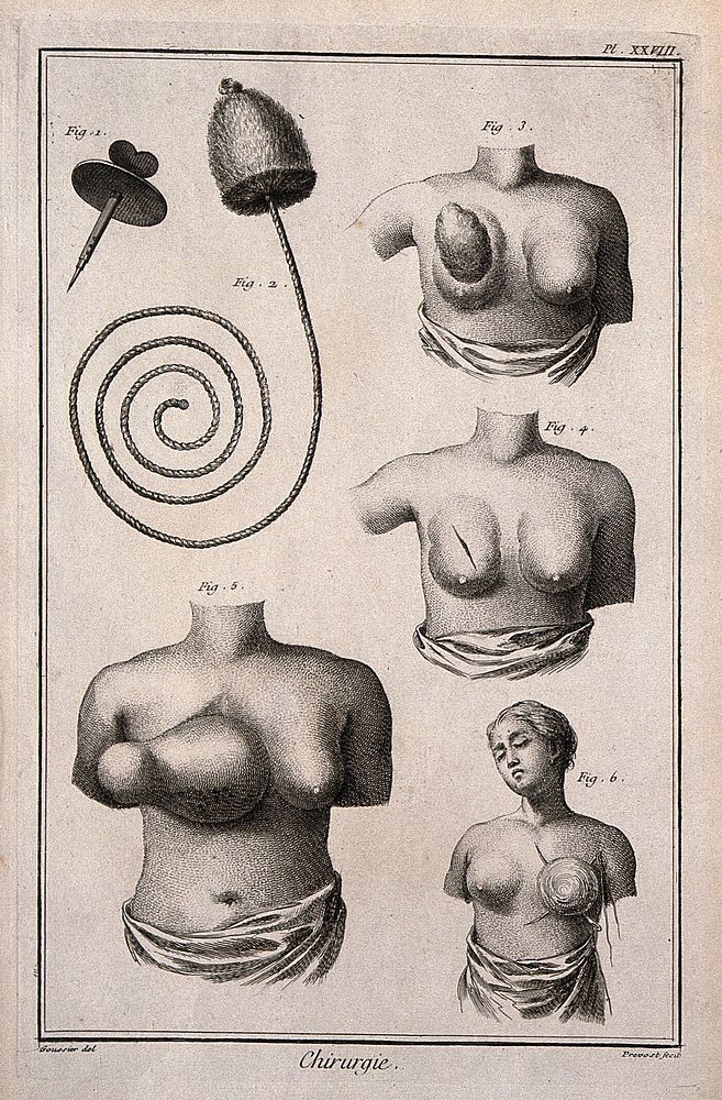 Surgery, top, instruments to perform a bronchostomy; below, breasts with tumours. Engraving with etching by B.L. Prevost…