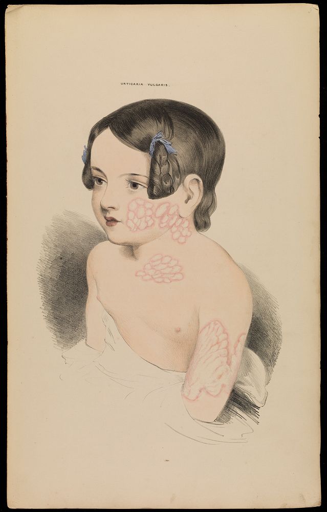 Illustrations of cutaneous disease : a series of delineations of the affections of the skin in their more interesting and…