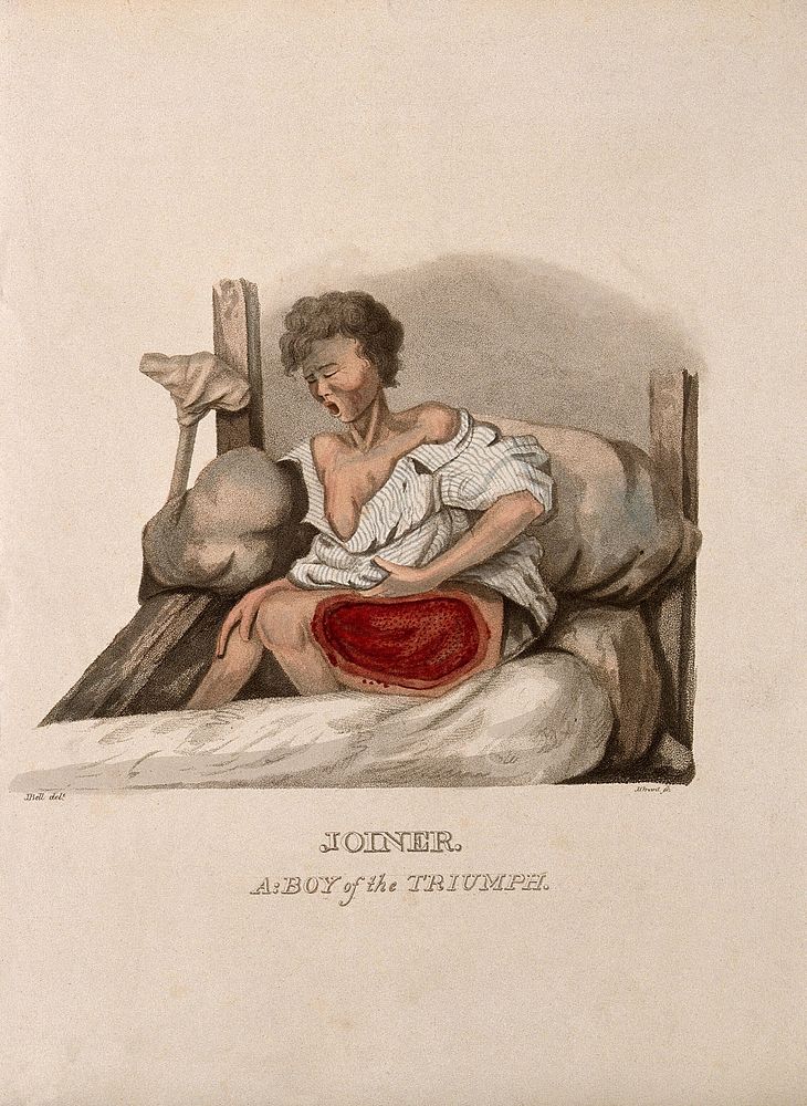 A boy with a wounded thigh seated on a bed; a crutch to his right. Coloured stipple etching by J. Grant after J. Bell, ca.…