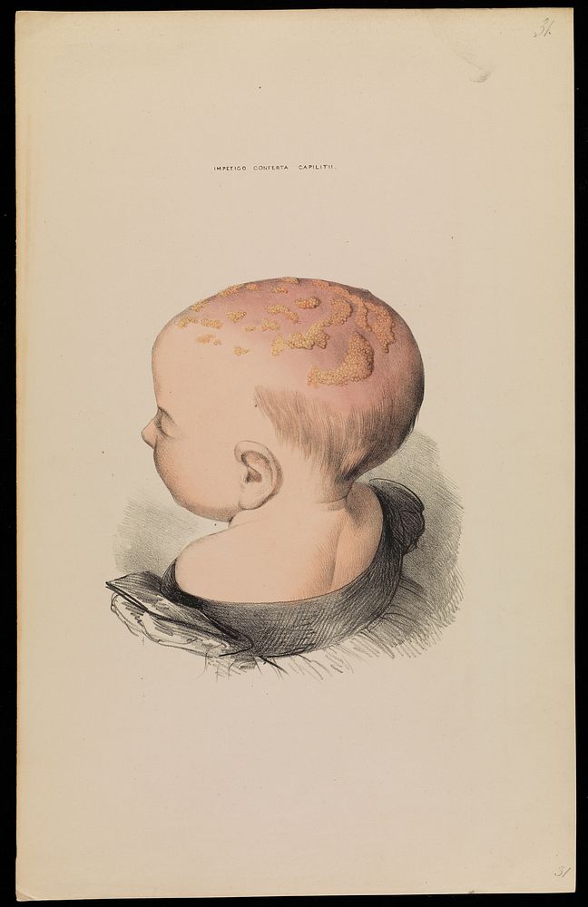 Illustrations of cutaneous disease : a series of delineations of the affections of the skin in their more interesting and…