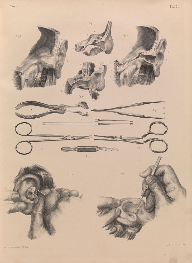 Plate 13. Surgical anatomy of the ear