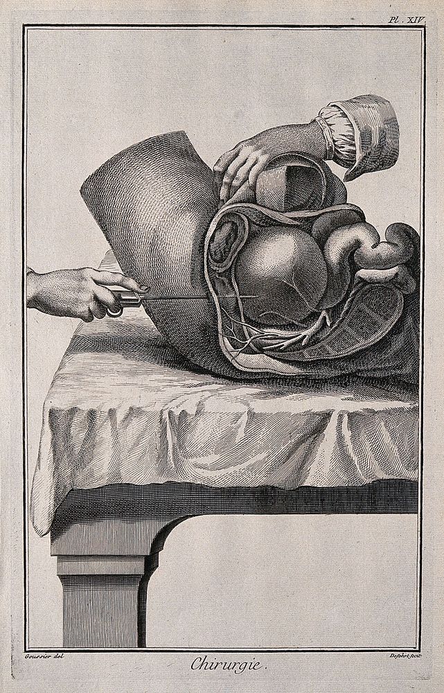 Surgery: lateral section of the hypogastrum. Engraving with etching by A.J. Defehrt after L.-J. Goussier.