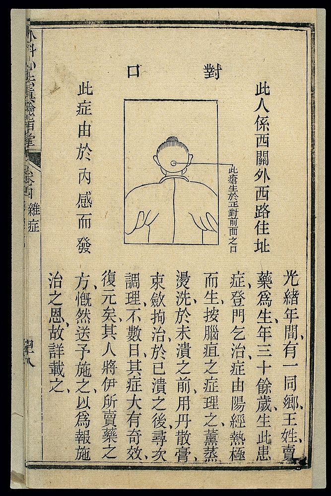 Chinese woodcut: Sores on the nape