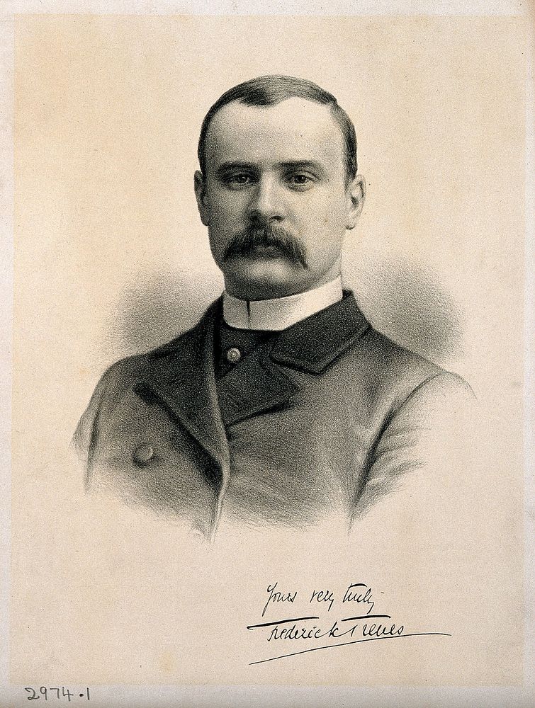 Sir Frederick Treves. Lithograph, 1884.