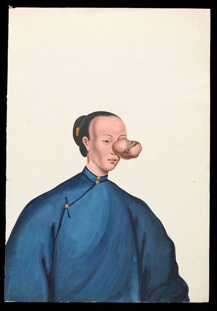 A woman, facing to right, with a large tumour covering her left eye. Gouache, 18--, after Lam Qua, ca. 1838.