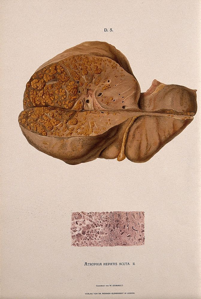 A diseased liver, including a section seen under a microscope, showing symptoms of atrophia hepatis acuta. Chromolithograph…