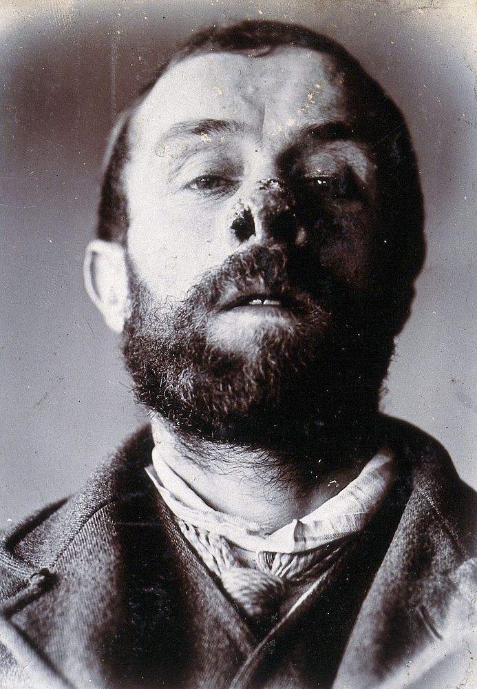 Friern Hospital, London: a man's face showing tuberculosis of the skin (lupus vulgaris). Photograph, 1890/1910.