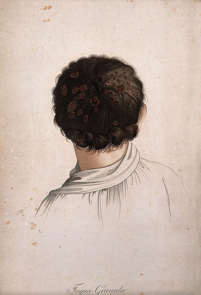 Back of head showing skin disease. Coloured stipple engraving by S. Tresca after Moreau-Valvile, c. 1806.