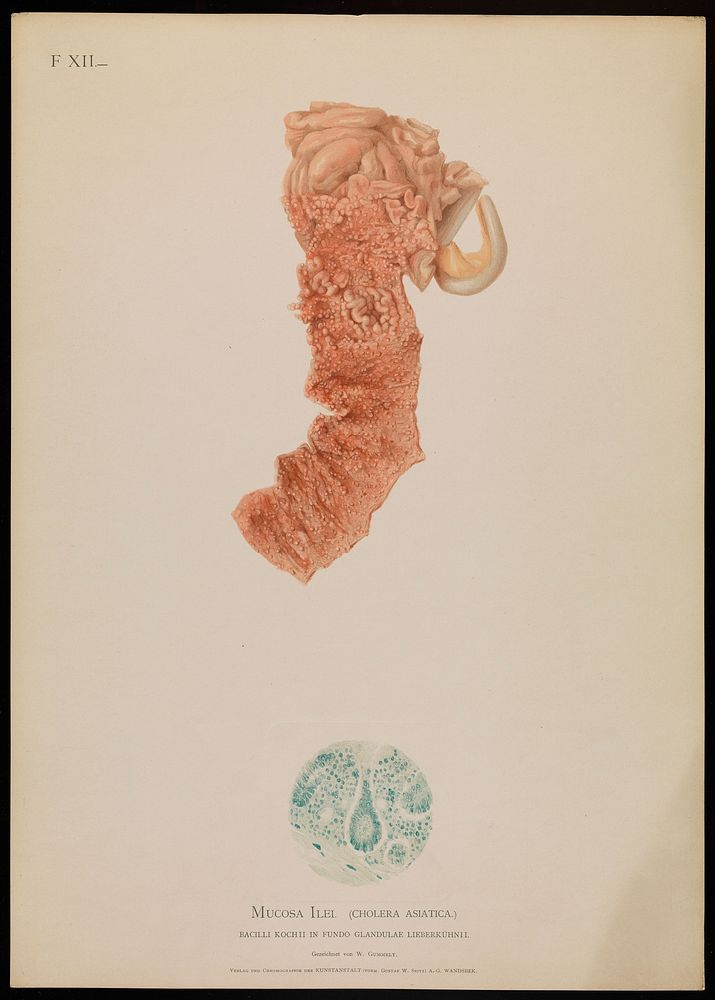 Illustrations of pathological anatomy : being a series of chromographed plates painted from nature immediately after death /…