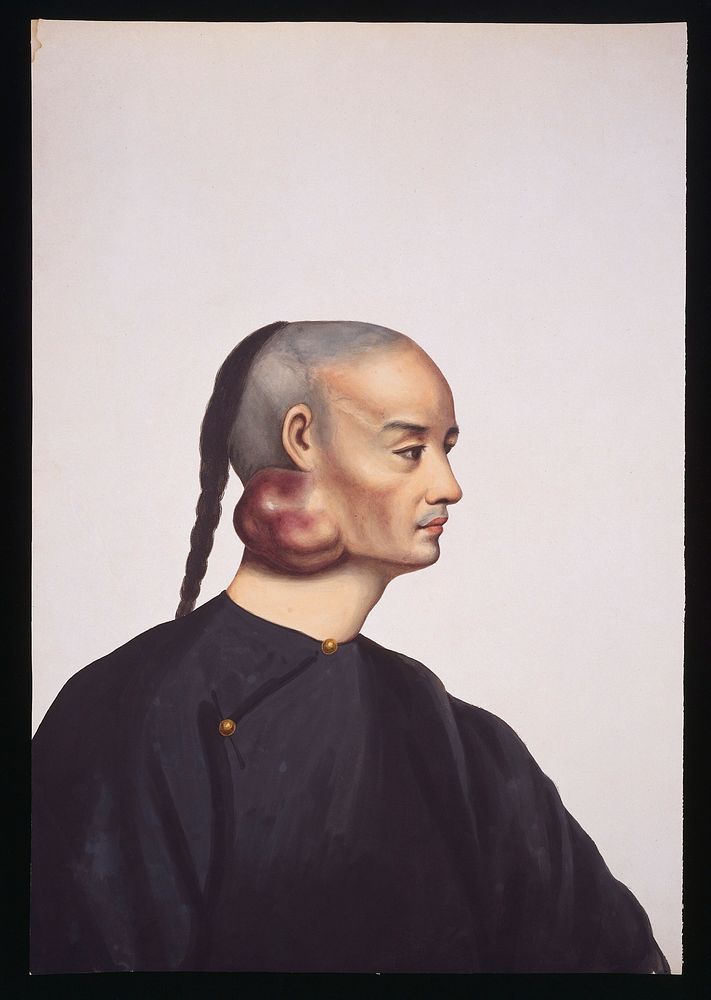 A man with a tumour below and behind his right ear. Gouache, 18--, after Lam Qua, ca. 183-.