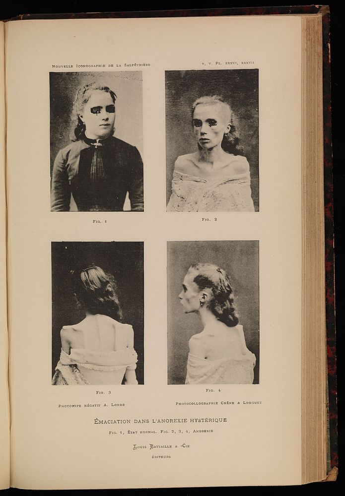 Four photographs of a woman, showing anorexia nervosa