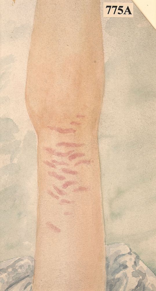 Arm of a girl admitted with burns, showing lineae transversae on the skin