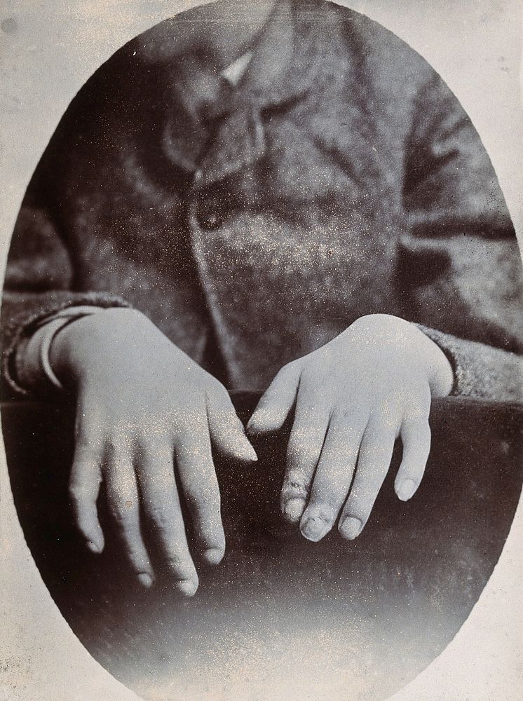 The hands of a child, showing deformity, particularly around the fingertips. Photograph by N. Goulton May.