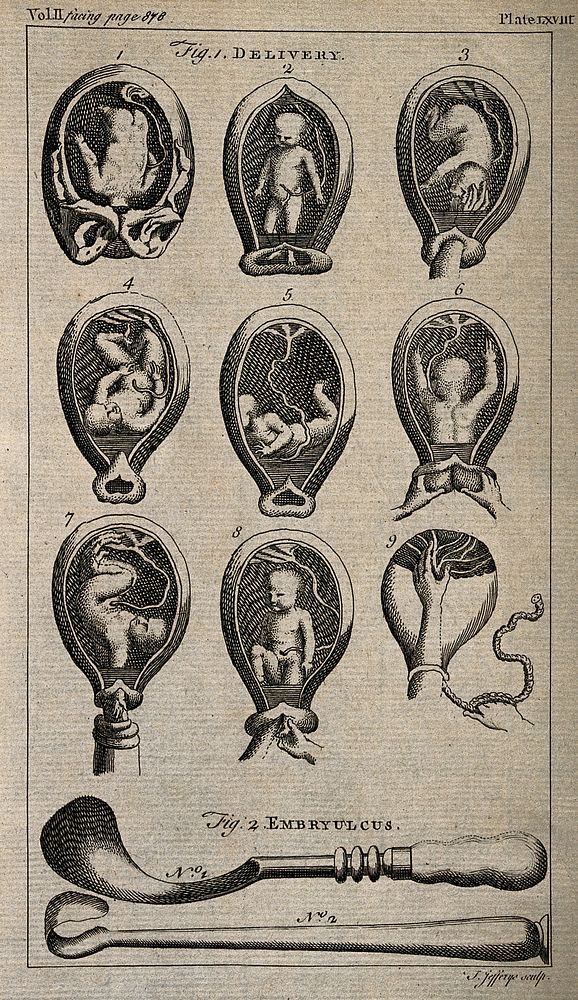 Nine diagrams of babies in the womb and two illustrations of obstetrical instruments. Etching by T. Jefferys.