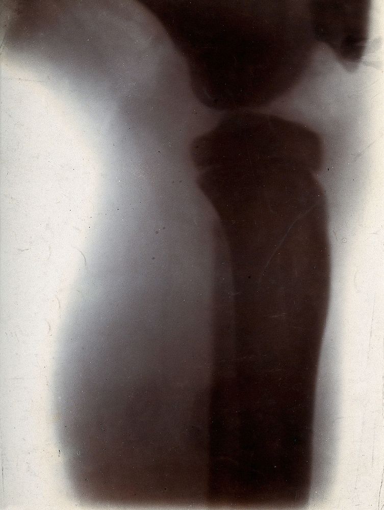 The bones of a knee joint of a boy, viewed through x-ray. Photoprint from radiograph after Sir Arthur Schuster, 1896.