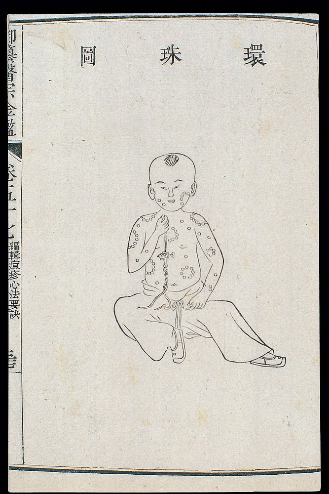 Chinese C18: Paediatric pox - 'Pearl Necklace' pox