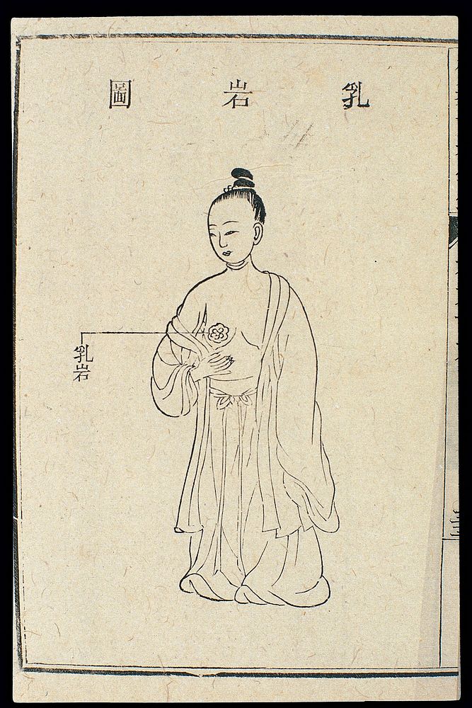 Chinese C18 woodcut: The chest/breasts - Breast tumour