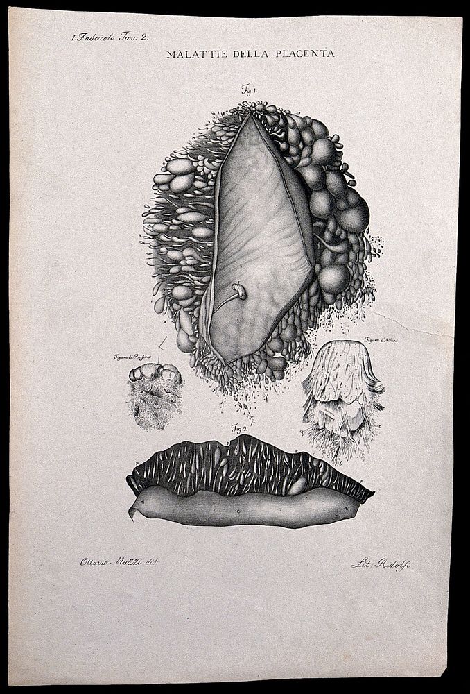 Four sections of diseased placenta, numbered for key. Lithograph by Ridolfi after Ottavio Muzzi, c. 1843.