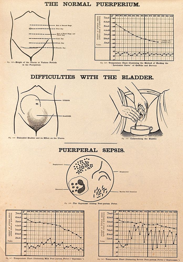 The normal puerperium, post-partum difficulties with the bladder, and puerperal sepsis. Lithograph after W. F. Victor Bonney.