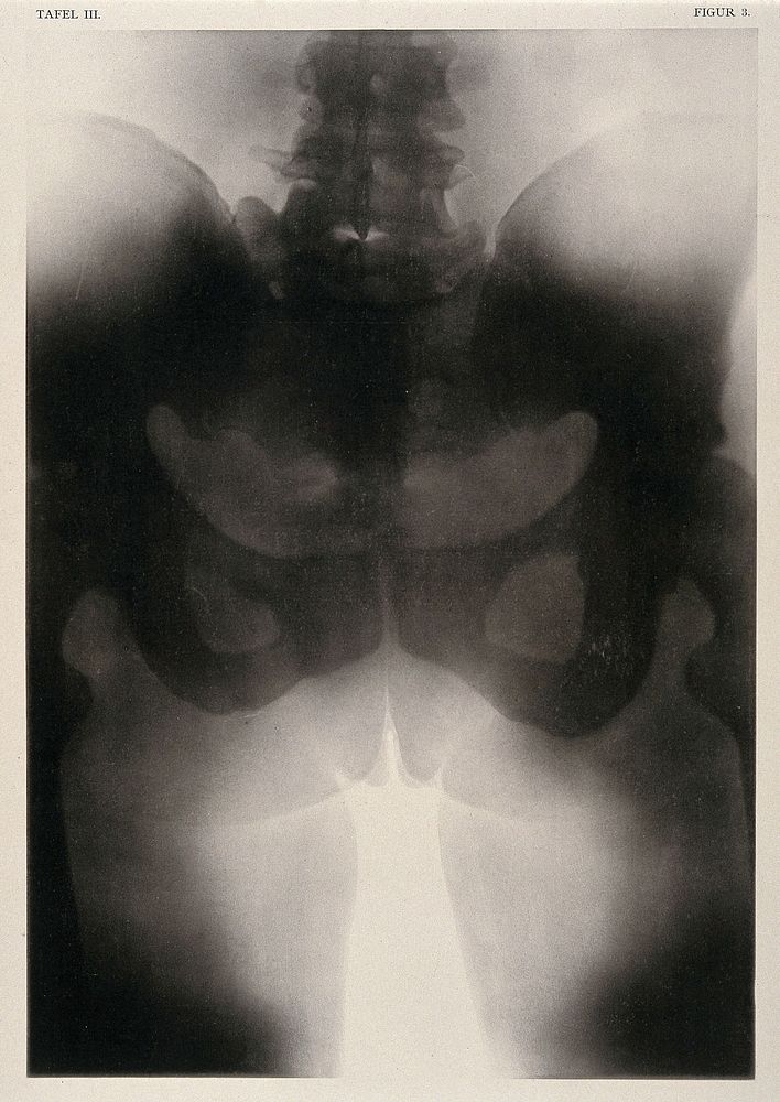 A woman's pelvis after a succesful pubiotomy - a surgical incision of the symphysis pubis generally to widen the birth canal…