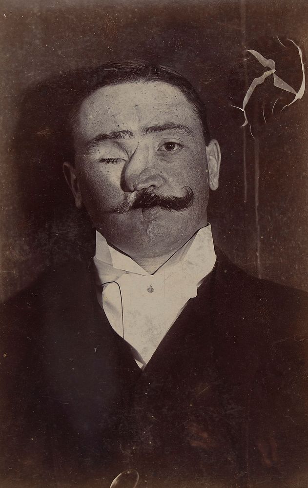 Face of a man whose nose had been reconstructed after a gun explosion