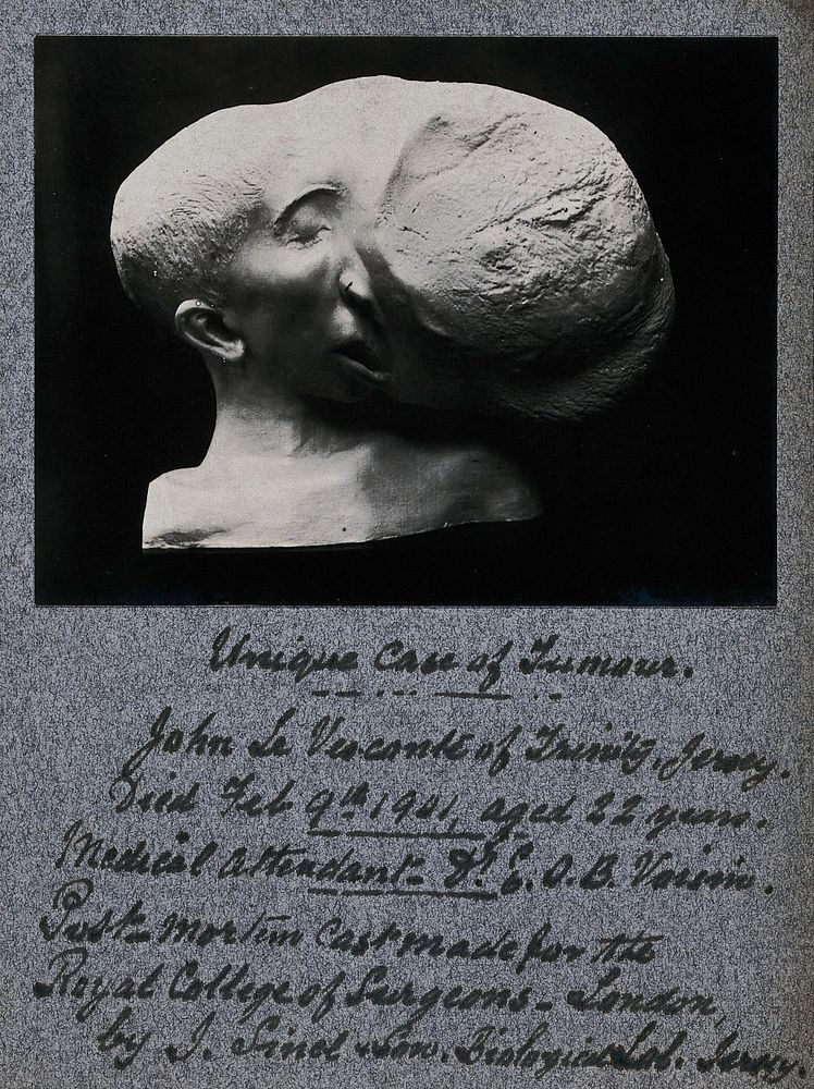Tumour on the face of the patient John Le Visconte: a post-mortem head and shoulders plaster cast. Photograph, ca. 1901, of…