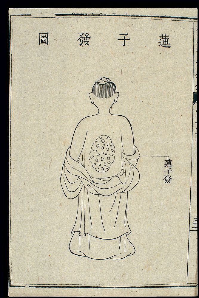Chinese C18 woodcut: External medicine - Lotus-seed' lesions