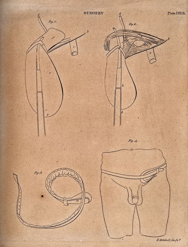 Surgical instruments for the treatment of hernias. Engraving by E. Mitchell.