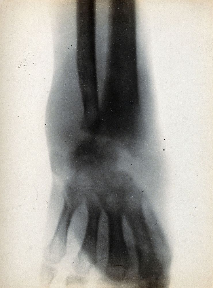 The bones of the wrist, viewed through x-ray. Photoprint from radiograph after Sir Arthur Schuster, 1896.