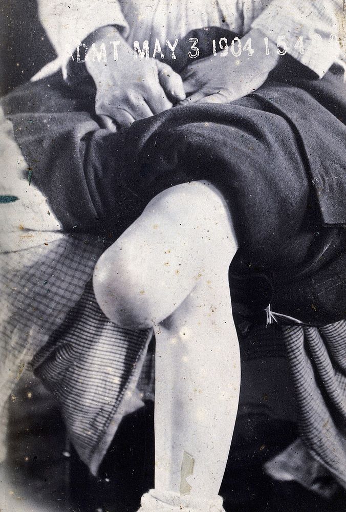 Friern Hospital, London: the knee of a seated person, with a large growth. Photograph, 1890/1910.