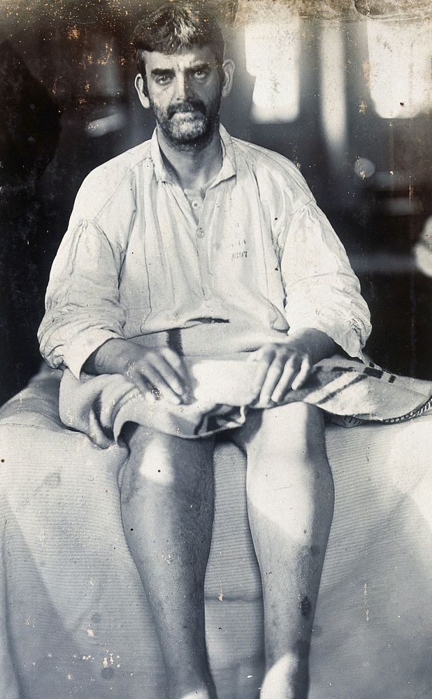 Friern Hospital, London: a seated man, wearing a hospital gown with a number stamped on it. Photograph, 1890/1910.
