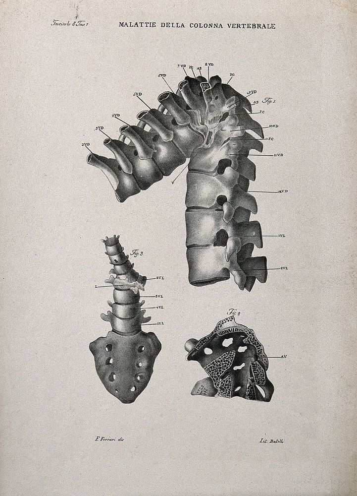 Three examples of diseased spine, numbered for key. Lithograph by Batelli after Ferdinando Ferrari, c. 1843.
