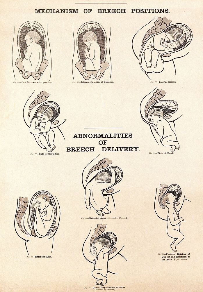 Mechanism of breech positions and abnormalities of breech delivery. Lithograph after W. F. Victor Bonney.